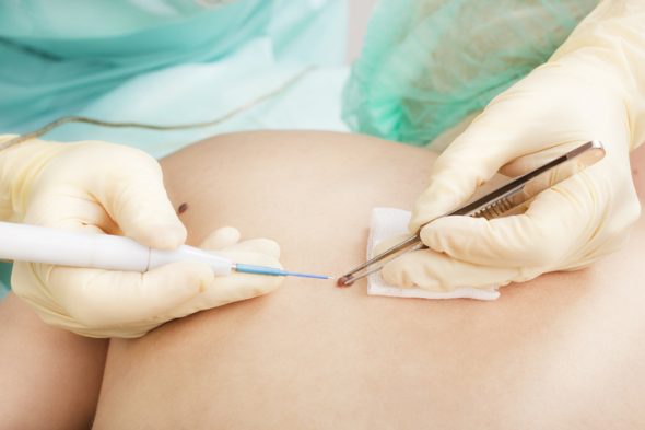 Doctor holding electrocautery and surgical tweezers while cutting the mole from the patient's back.